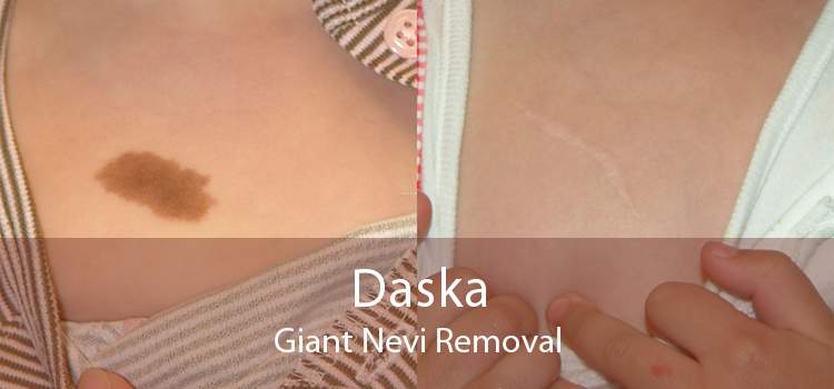 Daska Giant Nevi Removal