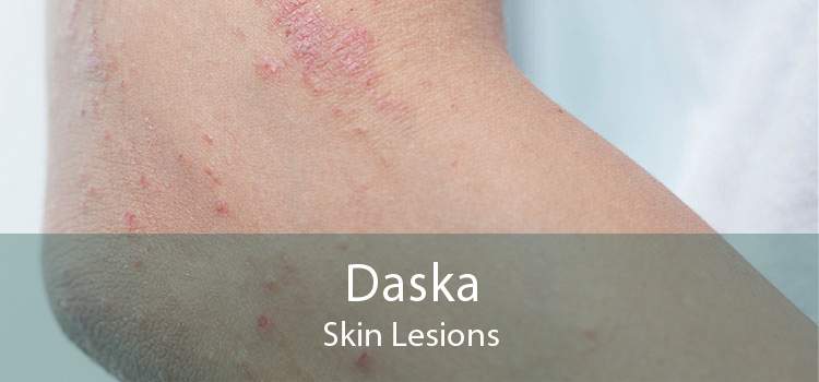 Daska Skin Lesions