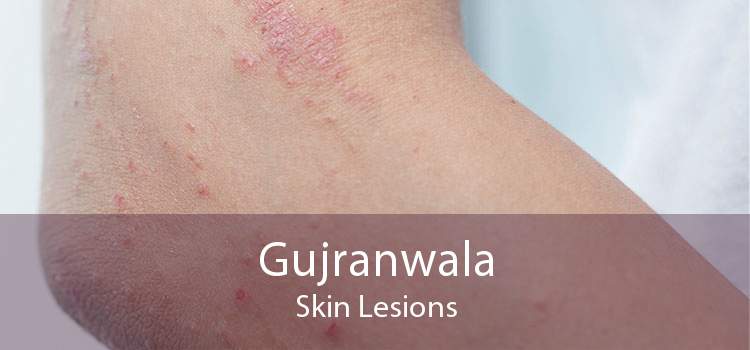 Gujranwala Skin Lesions