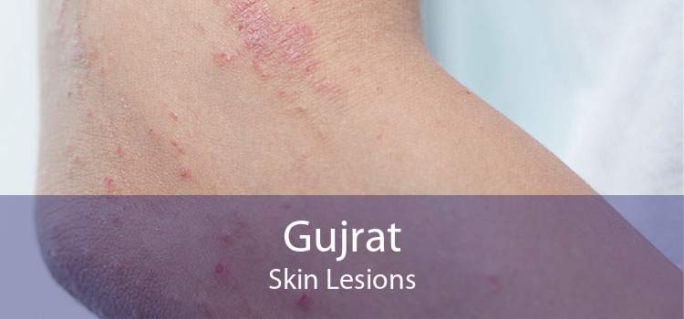 Gujrat Skin Lesions