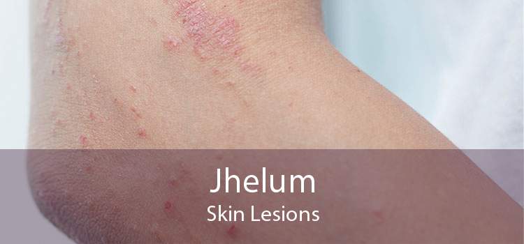 Jhelum Skin Lesions