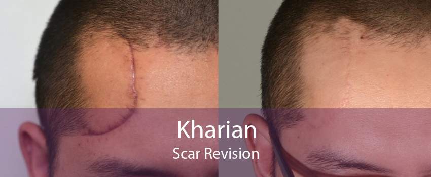 Kharian Scar Revision