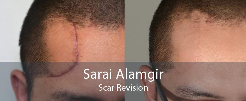 Sarai Alamgir Scar Revision