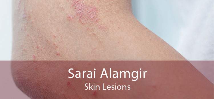 Sarai Alamgir Skin Lesions