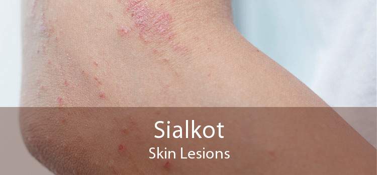 Sialkot Skin Lesions