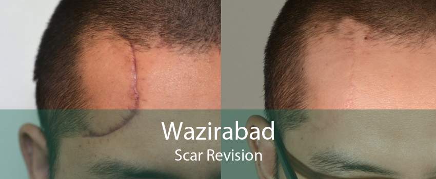 Wazirabad Scar Revision