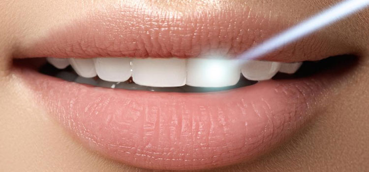 Whitening-Strips-and-Gels