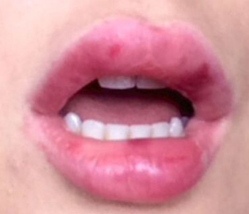 lip-treatment